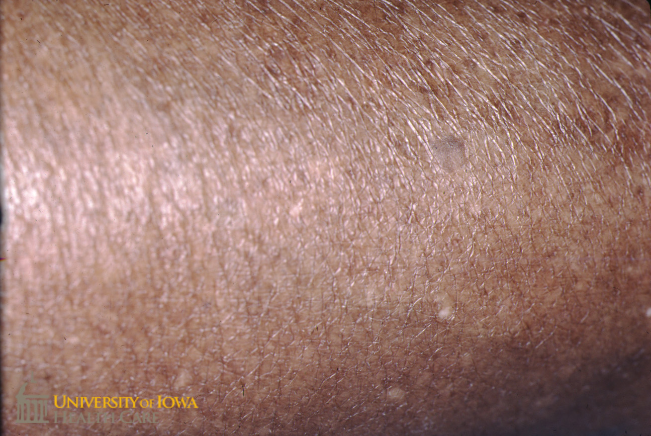 Numerous Hypopigmented Macules On The Extremity click Images For 